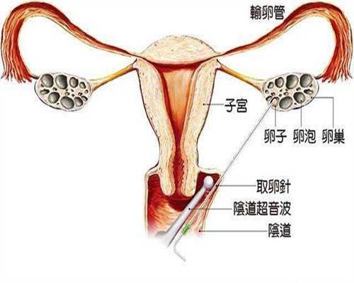 广州试管代怀孕