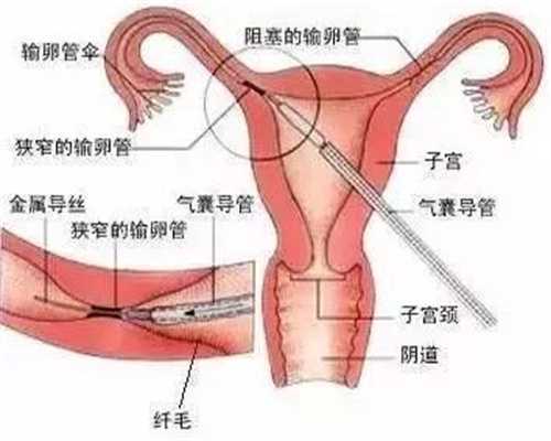 广州代怀孕生殖