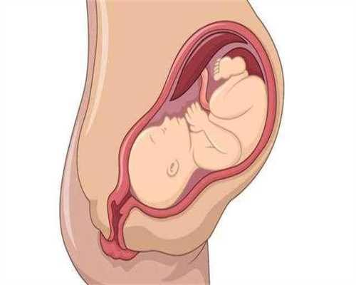 包成功代孕要多少钱-广州借腹生子生殖中心选性别_产妇因胎盘植入产后大出血